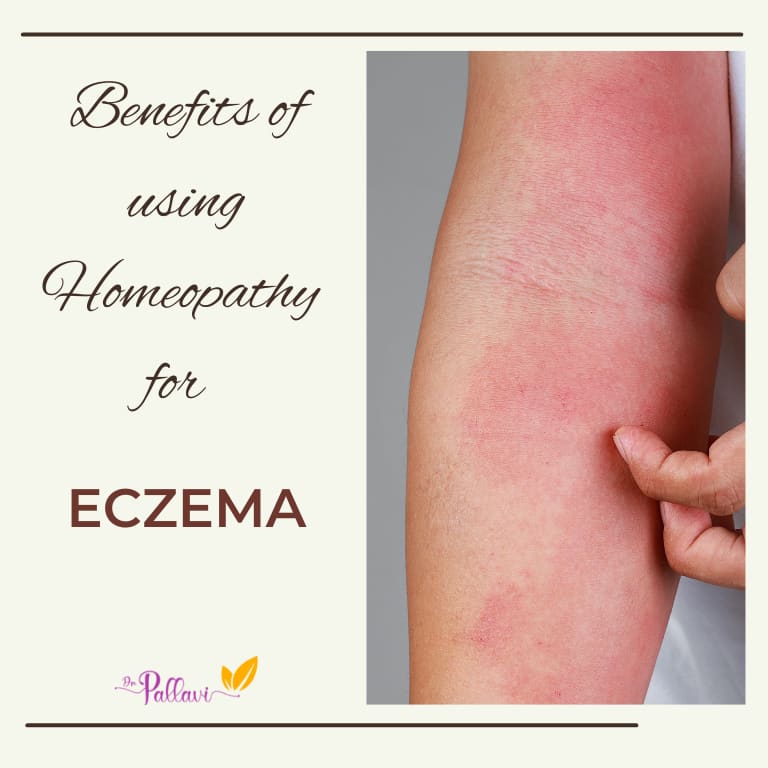 “Benefits of Homeopathy for ECZEMA”