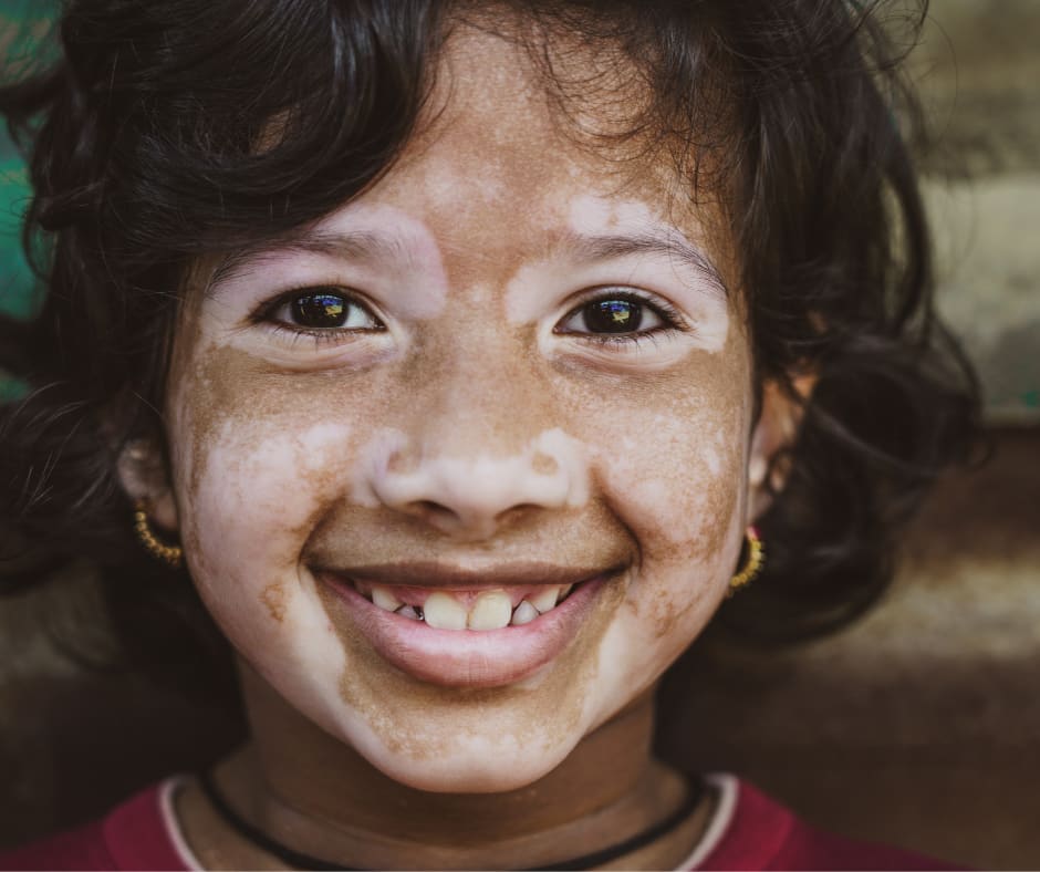 How can Homeopathy help in treating Vitiligo?