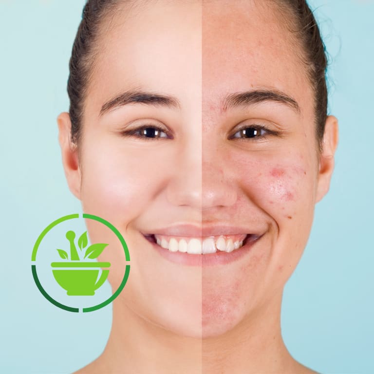 Why is Holistic medicine your best option for healing Acne?