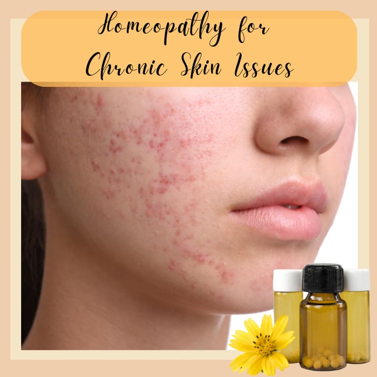 “Homeopathy for Chronic Skin Issues”