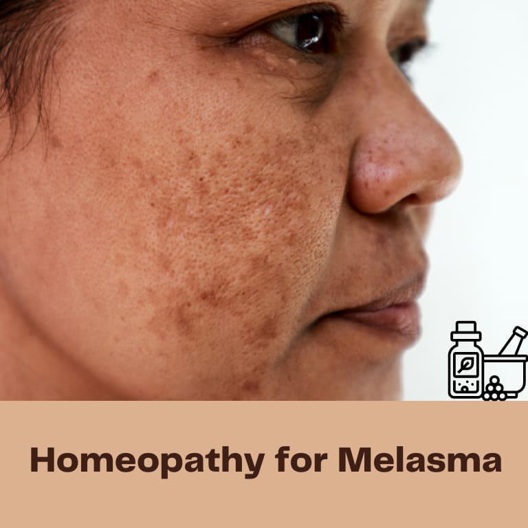 “Homeopathy for Melasma”