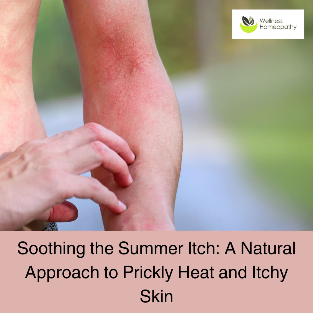 Summer Skin Bliss: A guide to natural relief for prickly heat and itchy skin. Enjoy the sun without the discomfort. Wellness Homeopathy – Your holistic partner for radiant skin.