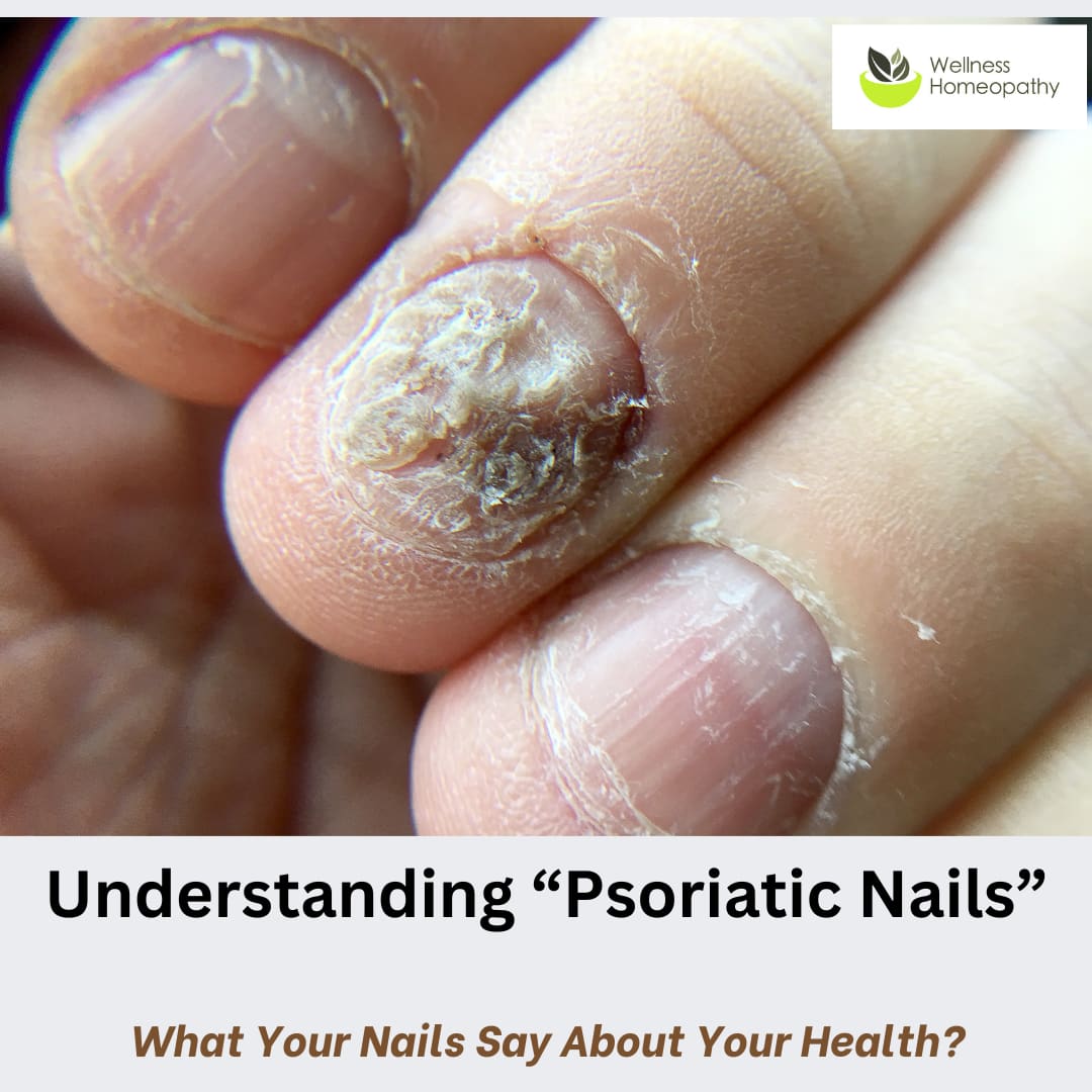 Understanding Psoriatic Nails: A Holistic Approach for Relief | Wellness Homeopathy NZ