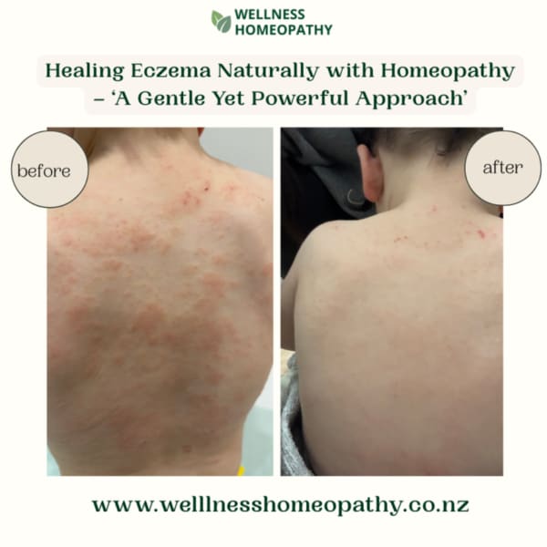 Healing Eczema Naturally with Homeopathy – A Gentle Yet Powerful Approach