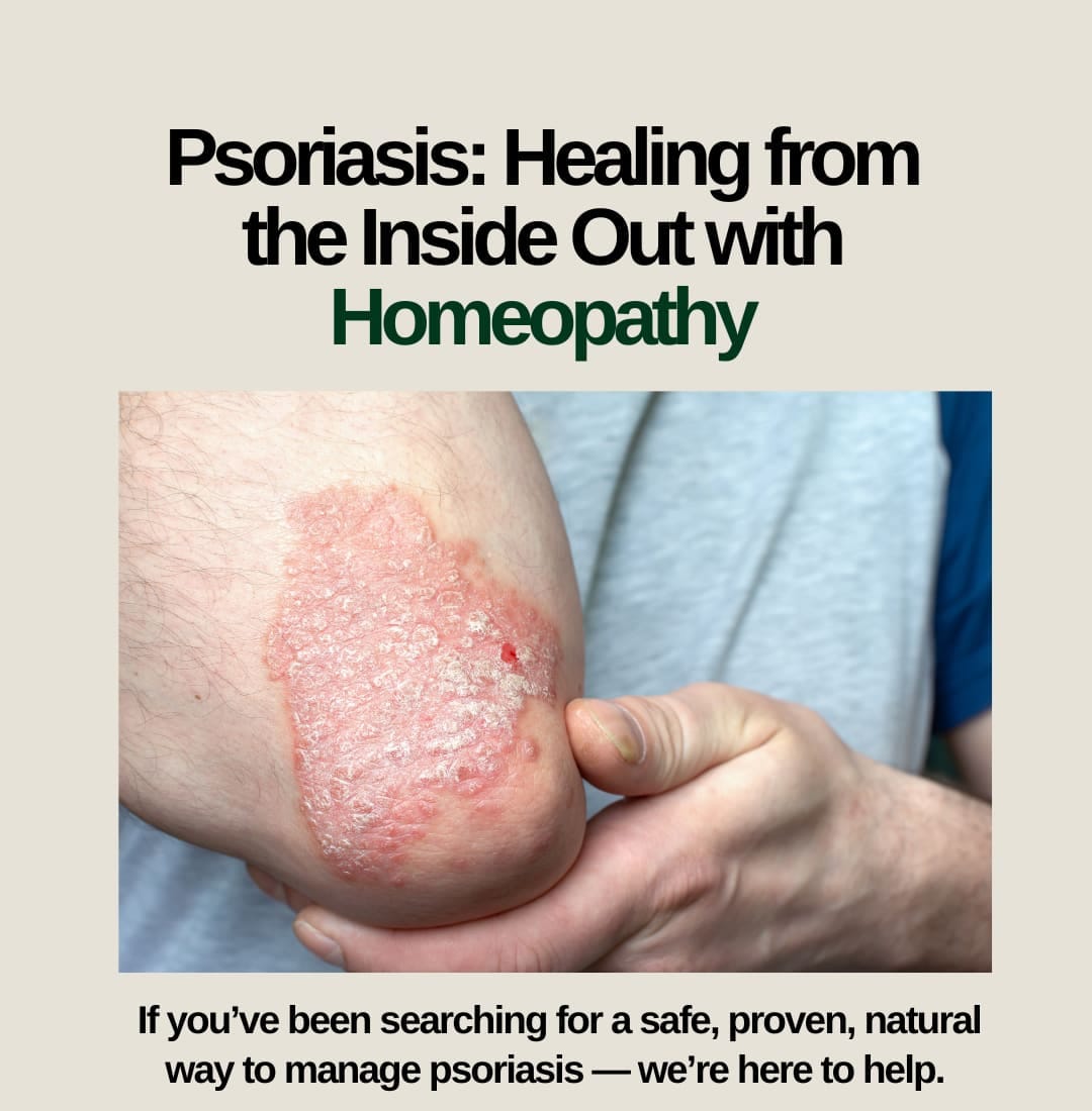 “Psoriasis”: Healing from the Inside Out with ‘Homeopathy’