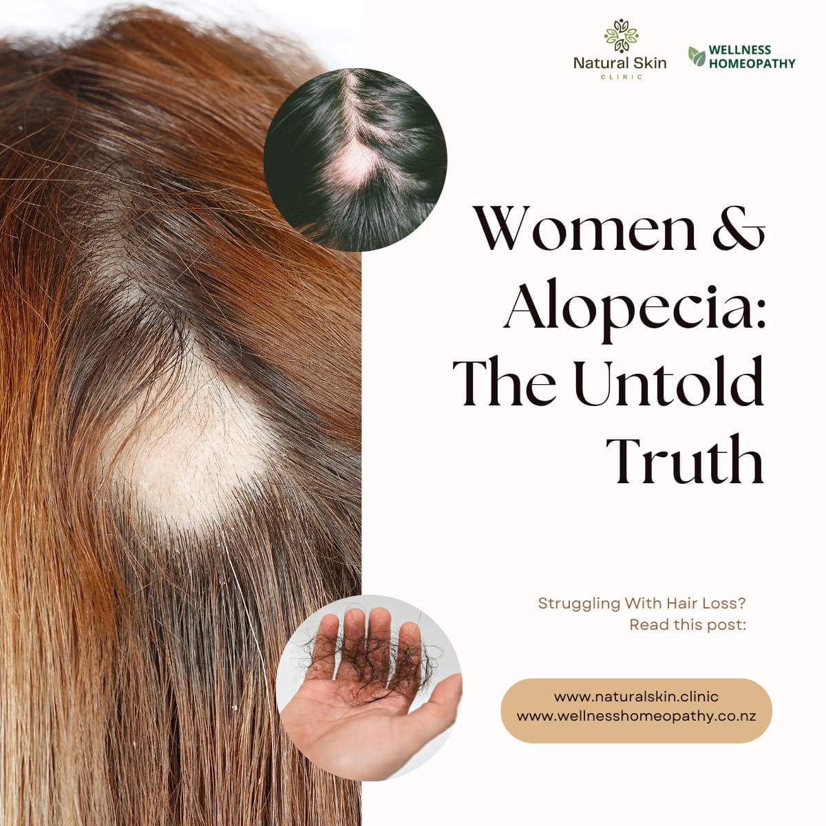 Alopecia in Women – Why it happens & how to fix it Naturally?