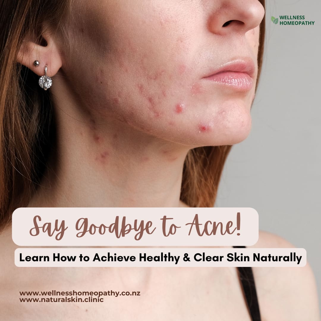 Say Goodbye to Acne- Learn How to Achieve Healthy & Clear Skin Naturally
